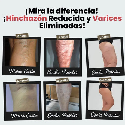 (Paga 1 y Recibe 1 Gratis) Calcetines de Acupresión Antivarices – Talla Universal (Compatible con cualquier tamaño).